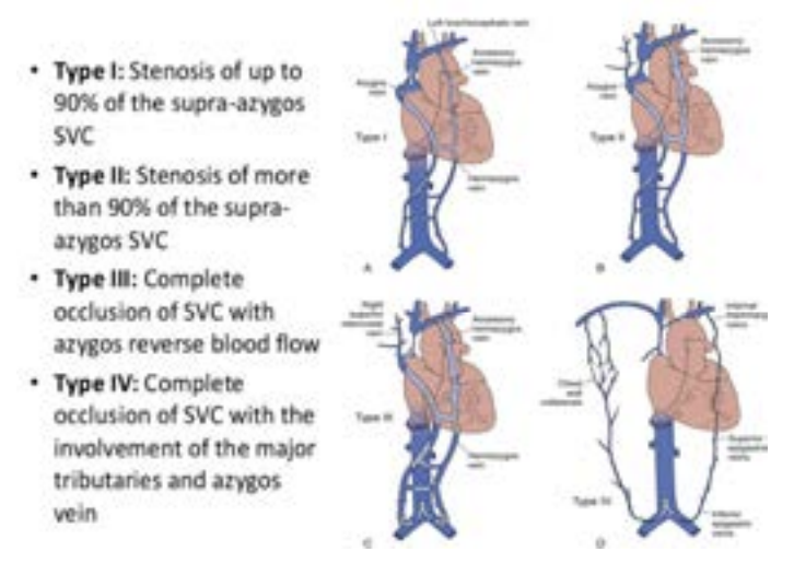 Endovascular Treatment of Superior Vena Cava Syndrome | VDM